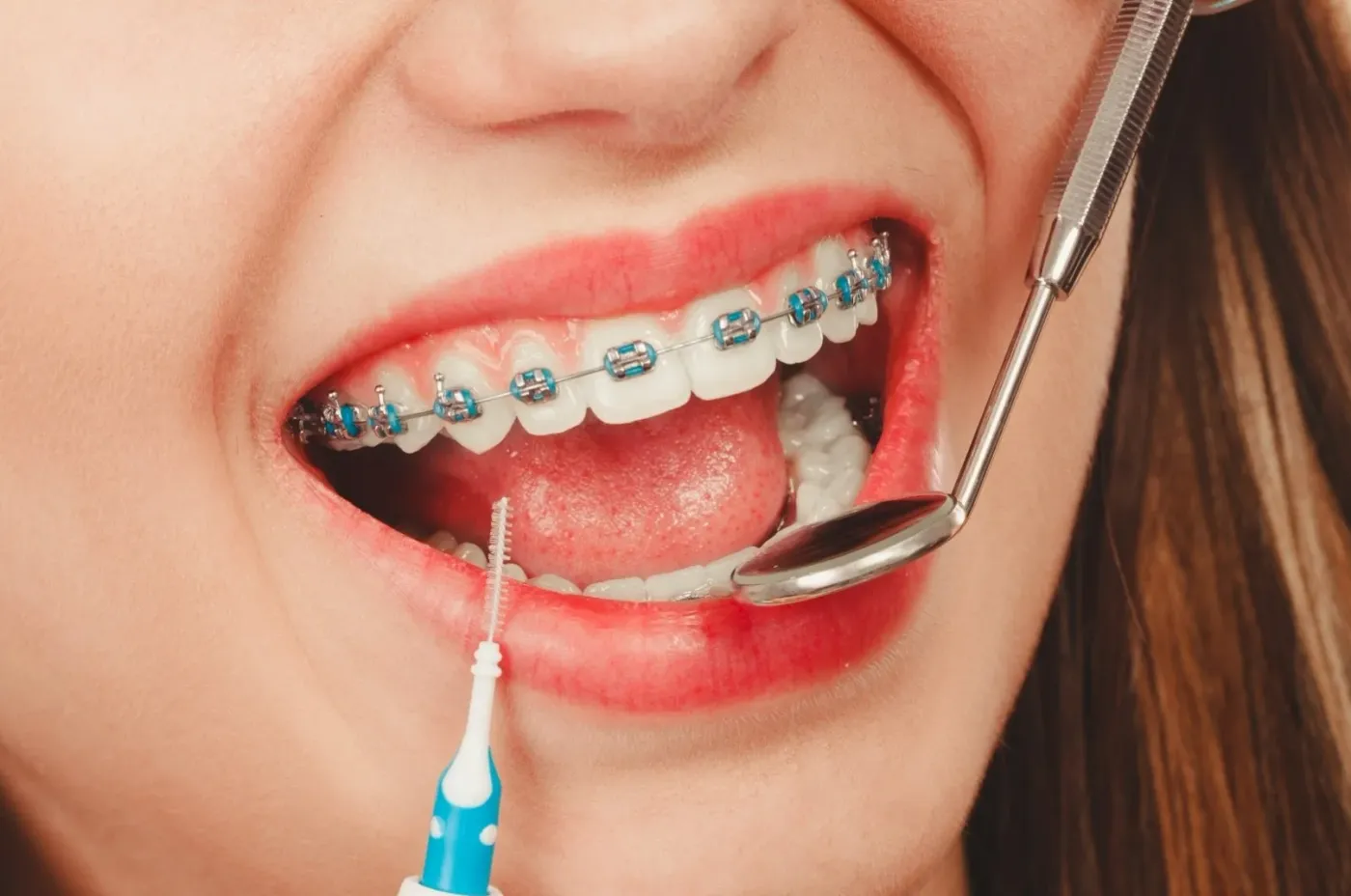 Orthodontics at Noho Dental Group